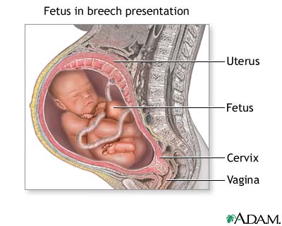 breech baby